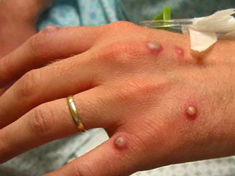 WHO: UK monkeypox cases are less severe variant
